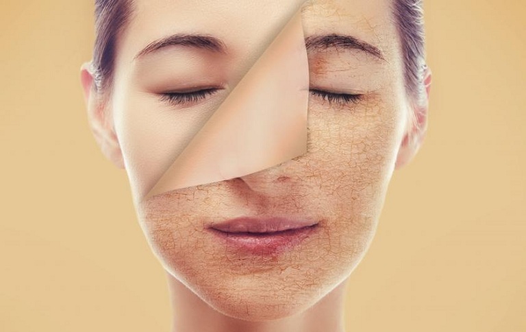Khô da mặt - Nguyên nhân và cách trị làm hết khô nhanh